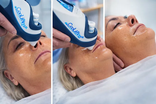 CooLifting behandling i ansikt