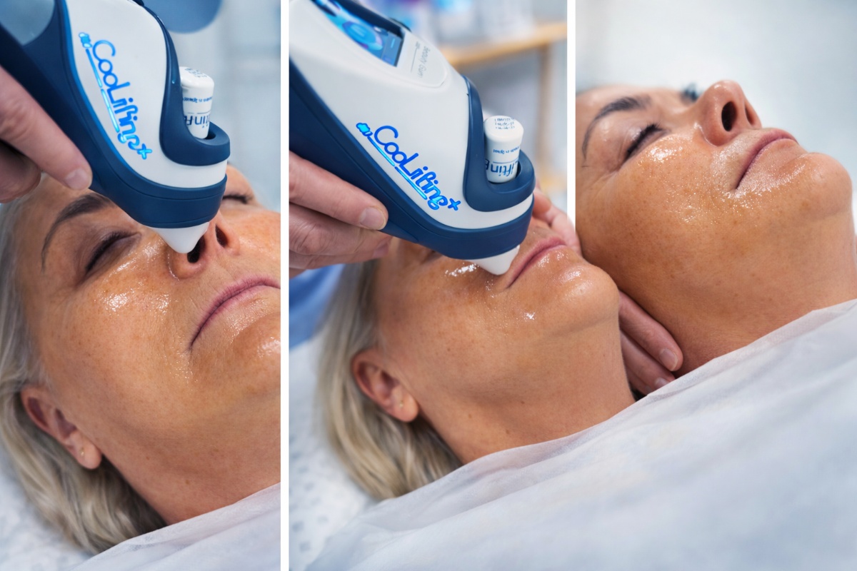CooLifting behandling i ansikt