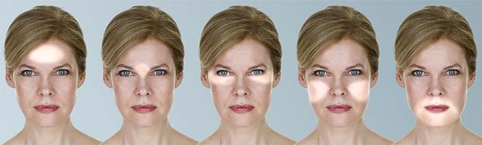 Illustrasjon av CooLifting-behandling